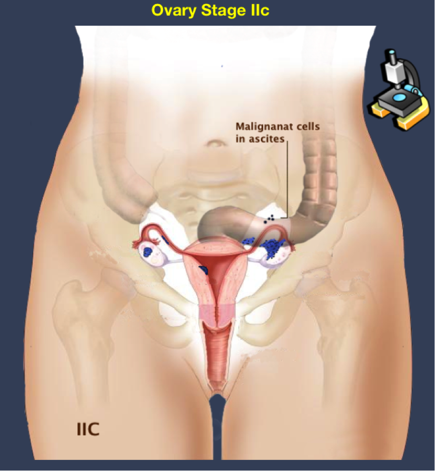 GINECOLOGIA TUMORES ginecologia tumores: